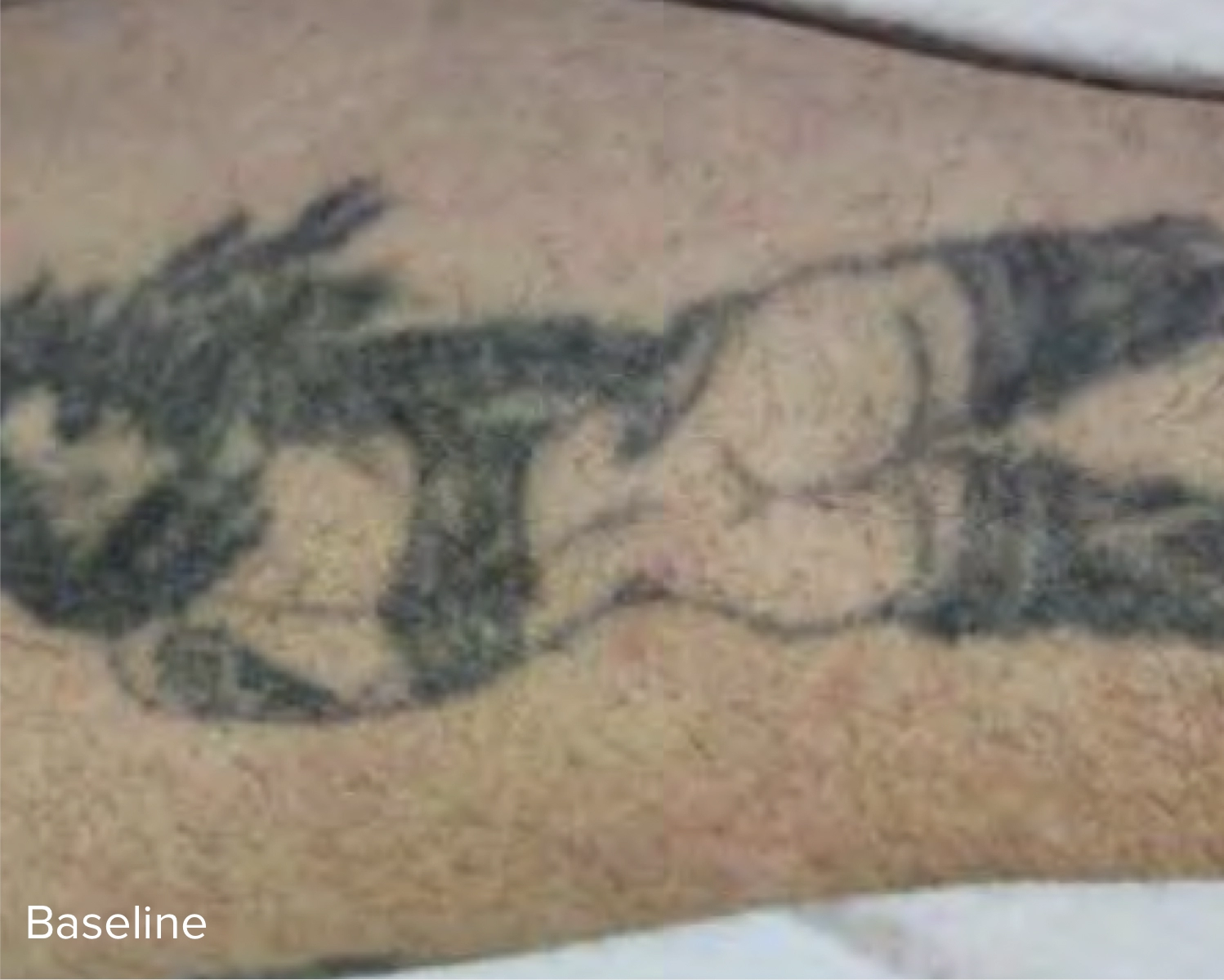 Baseline Laser Tattoo Removal Treatment