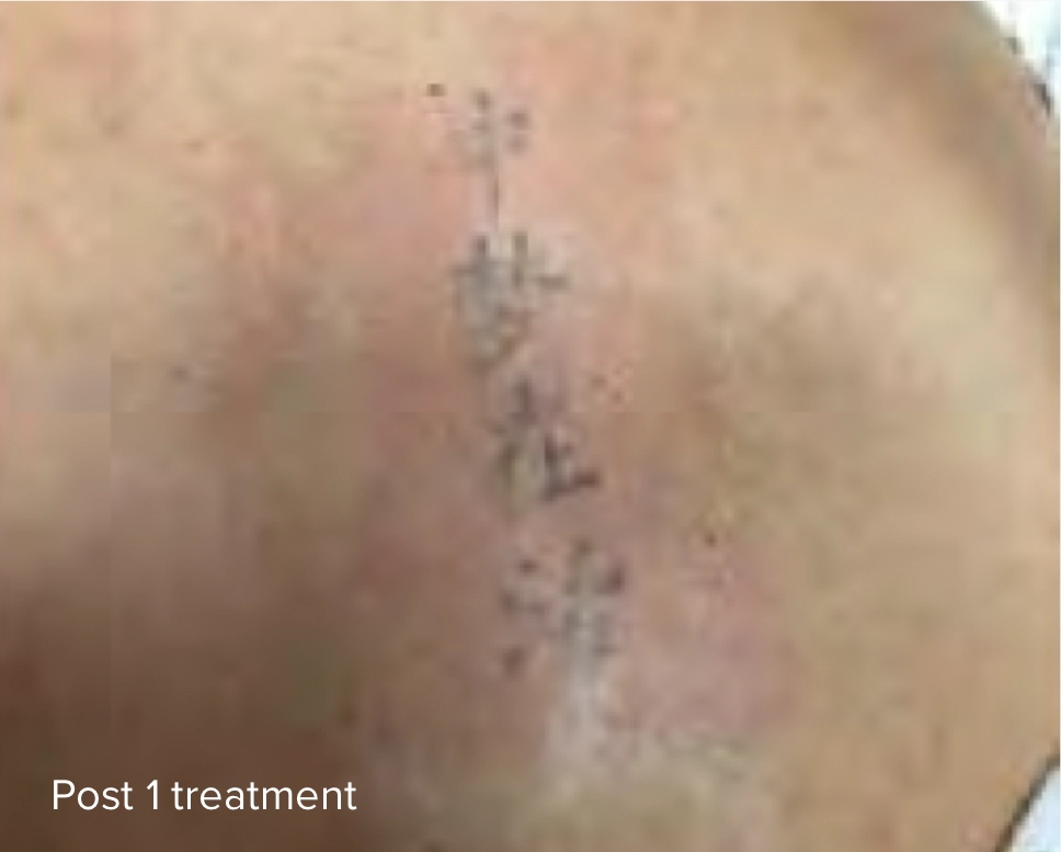 Body Laser Tattoo Removal Post 1 Treatment