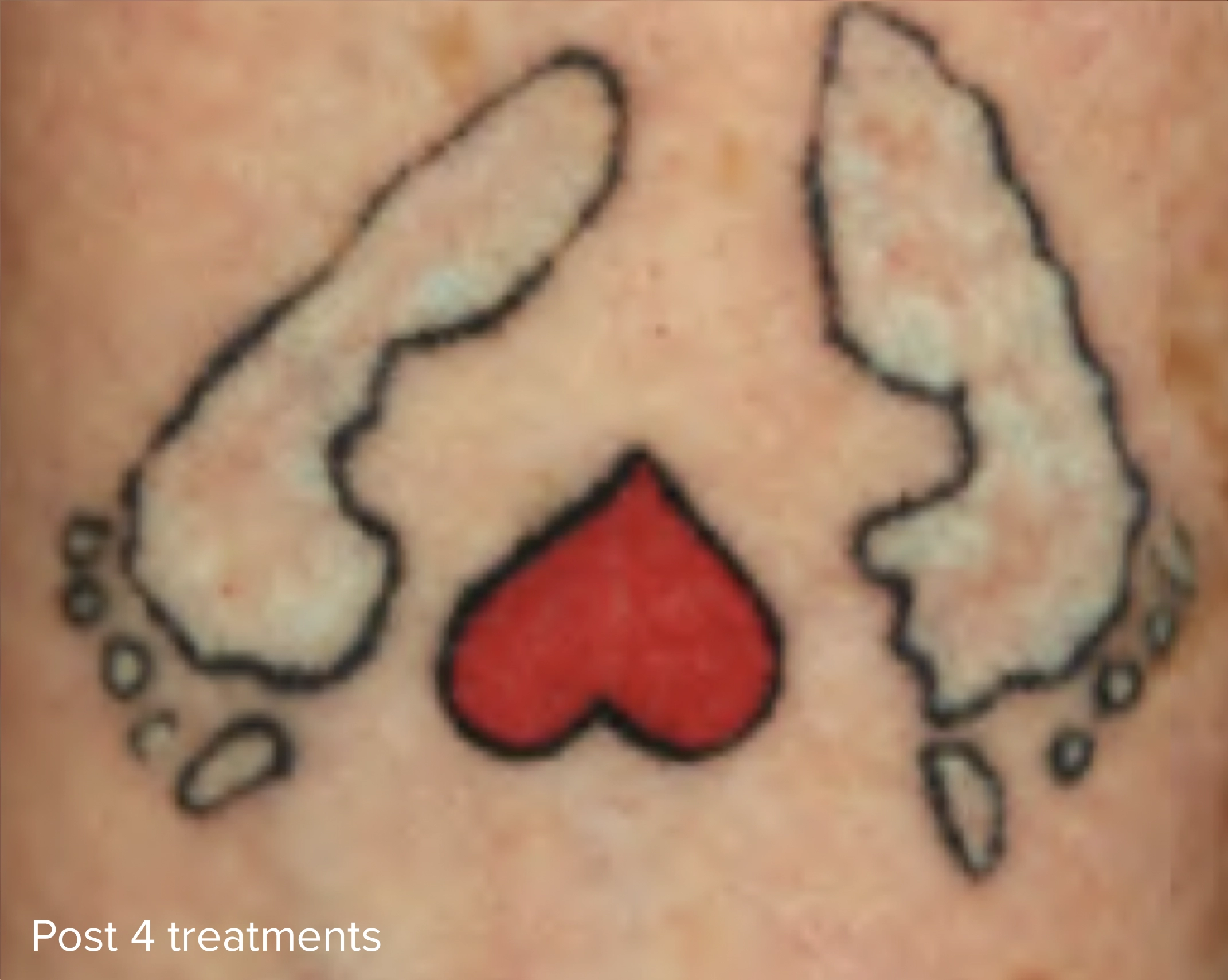 Colour Laser Tattoo Removal Post Treatments