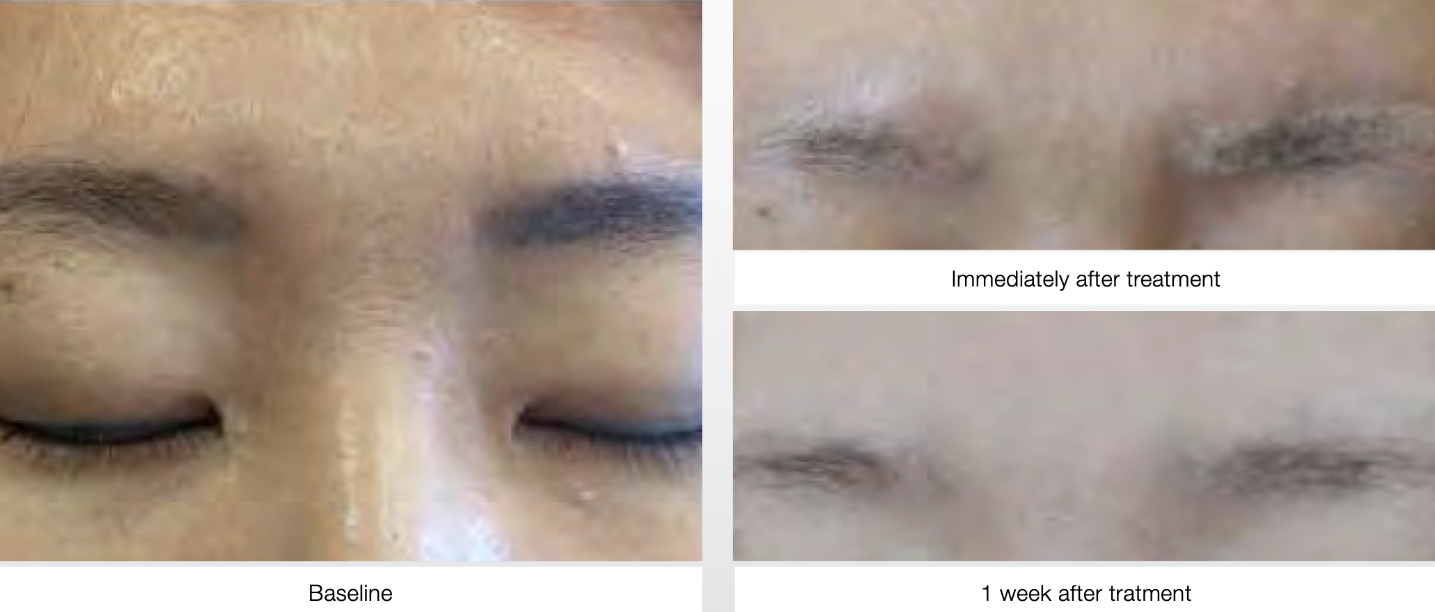 Eyebrow Laser Tattoo Removal Before After
