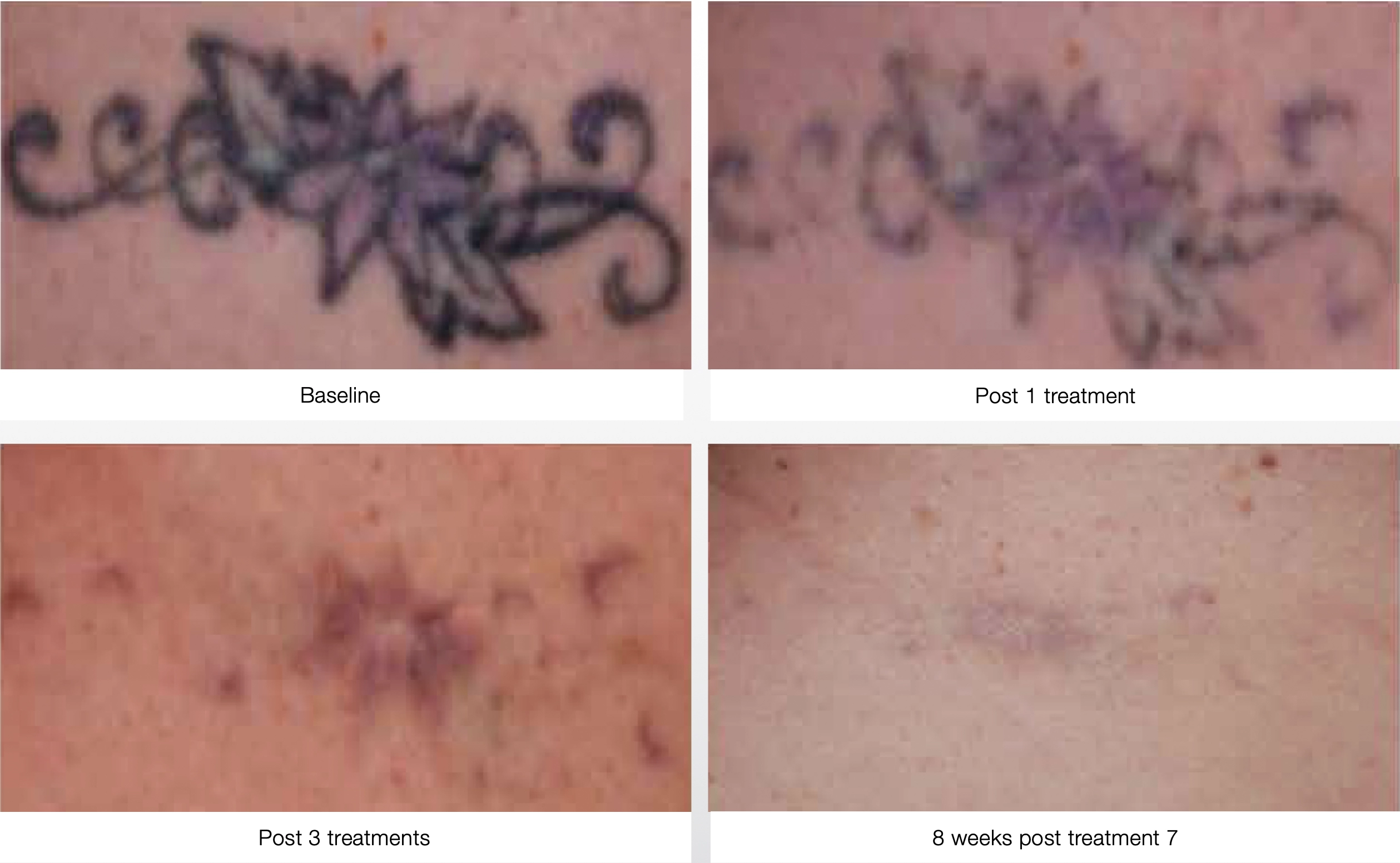 Laser Tattoo Removal Before After Treatments Post Week7