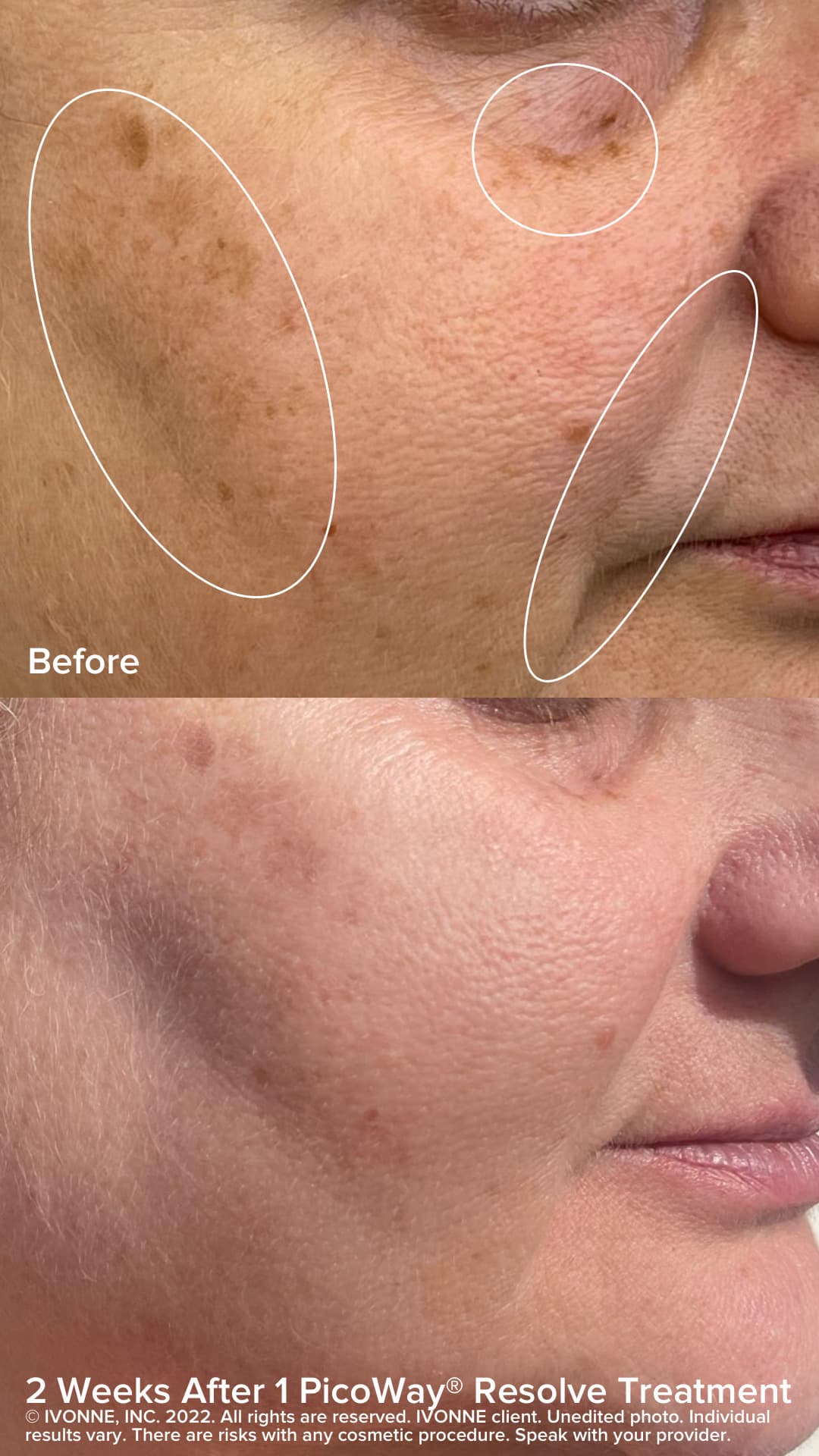 Melasma Treatments With PicoWay Laser Before After