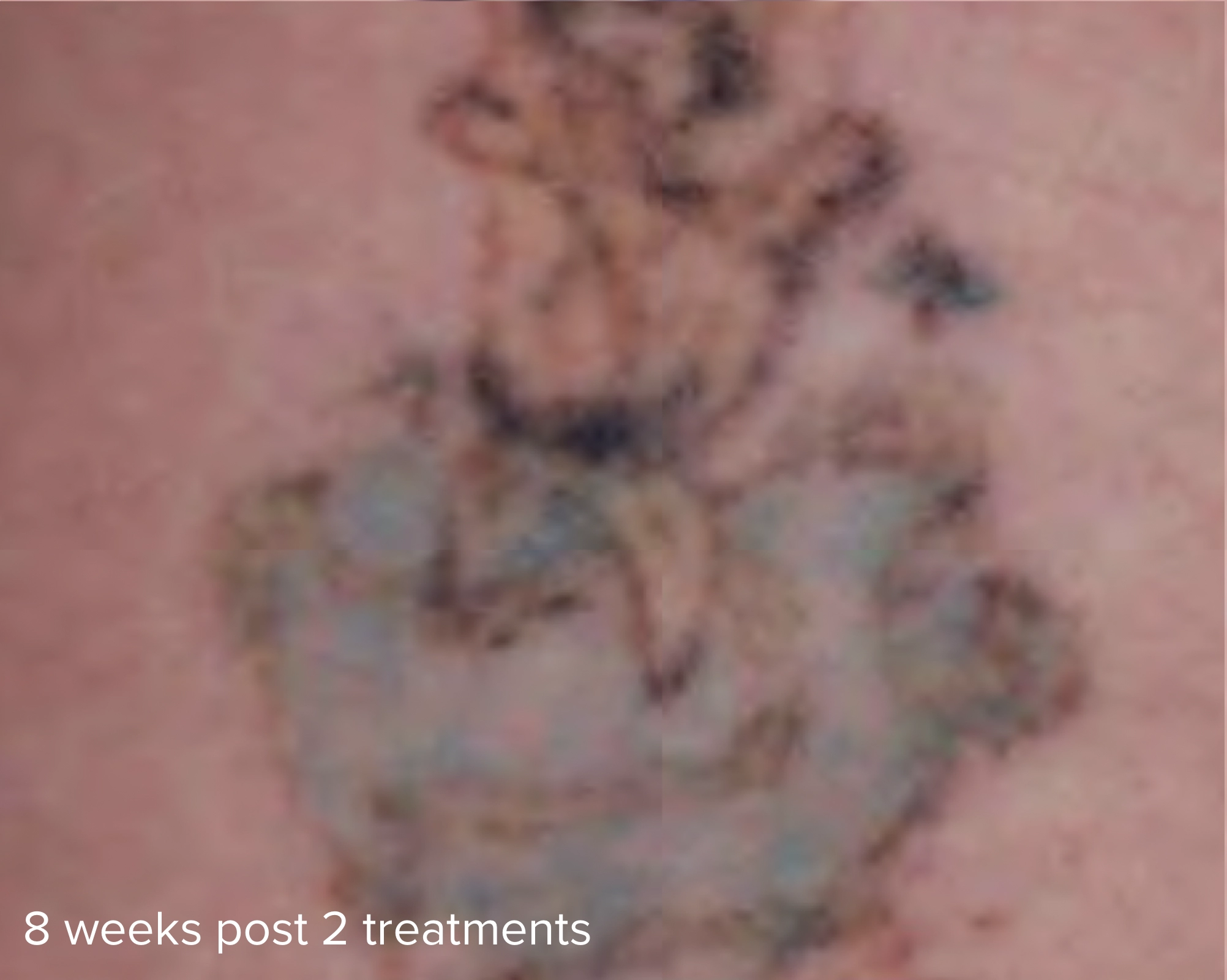 Multicolored Tattoo Removal 785nm 8 Weeks Post 2 treatments